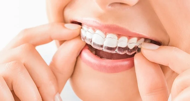تقويم الأسنان الشفاف: تصحيح الابتسامة دون معدن ظاهر